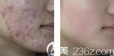 激光治療痤瘡疤痕前后效果對比照