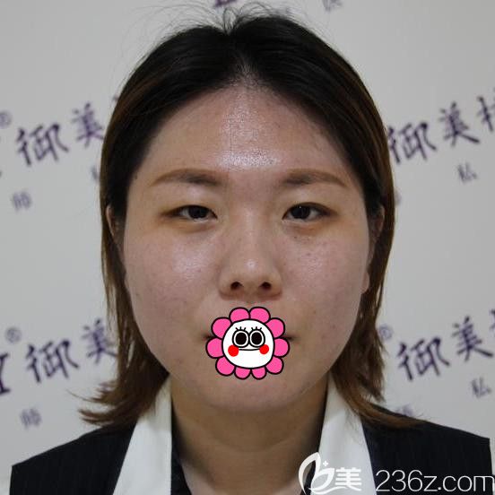 雞西御美樓做雙眼皮前 雞西御美樓做雙眼皮前