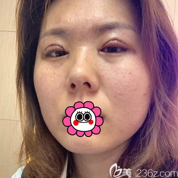 雙眼皮術(shù)后2天 雙眼皮術(shù)后2天