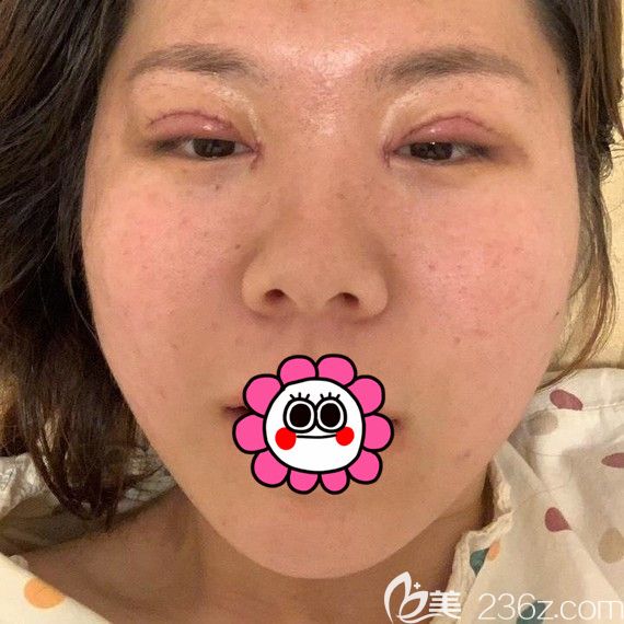 雙眼皮術(shù)后5天 雙眼皮術(shù)后5天