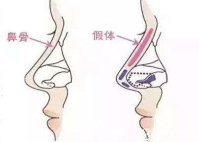 假體隆鼻后遺癥有那些？