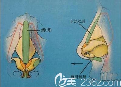 假體隆鼻一定會出現(xiàn)后遺癥嗎？