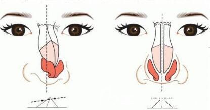 假體隆鼻出現(xiàn)后遺癥應(yīng)該怎么辦呢？