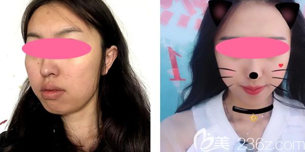 案例一：全臉線雕提升真人案例效果對(duì)比圖