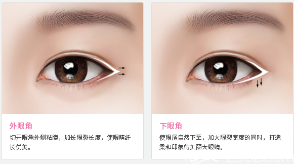 廣州廣大整形醫(yī)院王政醫(yī)生雙眼皮示意圖 廣州廣大整形醫(yī)院王政醫(yī)生雙眼皮示意圖