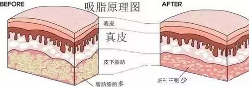 吸脂手術(shù)的原理示意圖