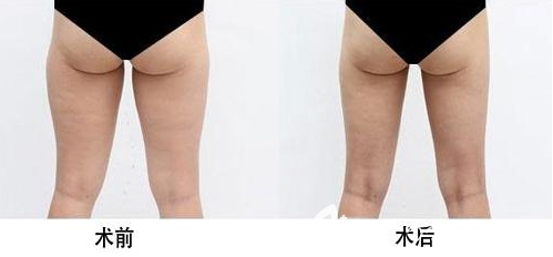 大腿吸脂術(shù)后效果圖