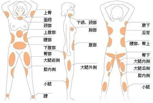 人體吸脂部位分布圖