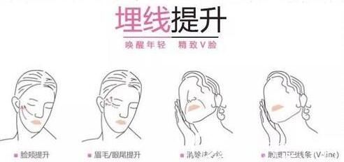 面部埋線提升能夠維持多久？