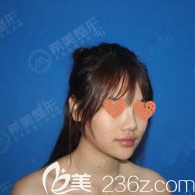 做鼻綜合術(shù)前照 做鼻綜合術(shù)前照