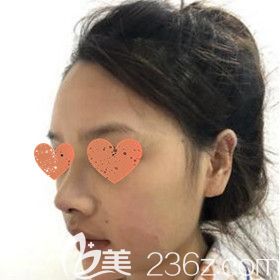 做自體軟骨鼻綜合術(shù)后1天照 做自體軟骨鼻綜合術(shù)后1天照