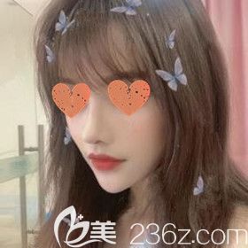 在長沙希美醫(yī)療美容做了肋軟骨鼻綜合后我終于擁有迷人小翹鼻了！