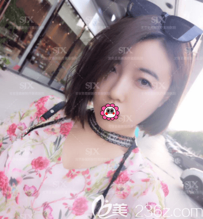 邱立東做脂肪填充好嗎？我在北京圣嘉新做SVF三聯(lián)脂肪活顏術(shù)一個(gè)月效果參考