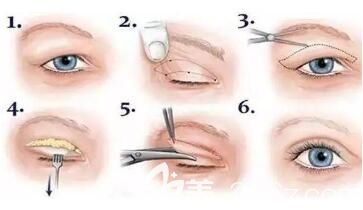 雙眼皮手術(shù)過程示意圖