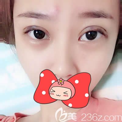 泉州歐菲胡利韜主任為我做雙眼皮術(shù)后一周效果