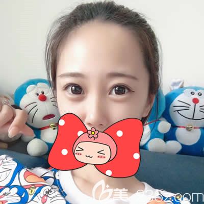 泉州歐菲胡利韜主任為我做雙眼皮術(shù)后20天效果