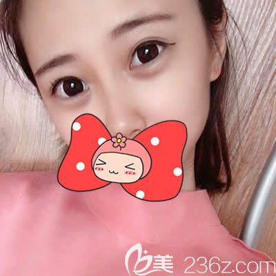 自從找泉州歐菲胡利韜主任做完雙眼皮后我真的是賺足了回頭率