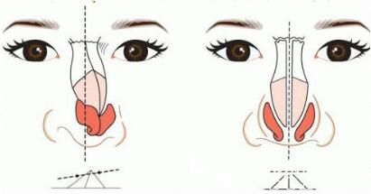 硅膠假體隆鼻可以放一輩子嗎？