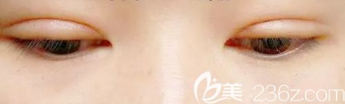 做完雙眼皮手術(shù)后1年后還有肉條