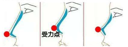 假體隆鼻受力點