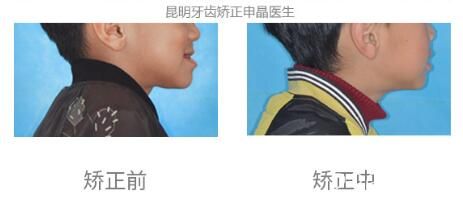 通過(guò)申晶院長(zhǎng)牙齒矯正案例和顧客評(píng)價(jià)來(lái)看口腔北京路怎么樣？