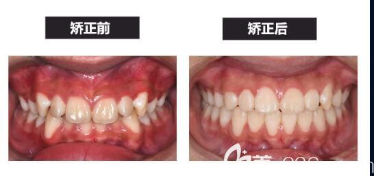 申晶院長(zhǎng)深覆合矯正案例
