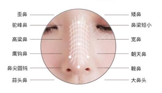 仿生綜合隆鼻技術(shù)優(yōu)勢介紹