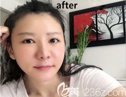 糾結韓國bio醫(yī)院誰做眼睛好？干醫(yī)美的表姐說除了曹仁昌,辛容鎬雙眼皮修復也不錯！