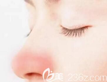 隆鼻后鼻子一直發(fā)紅怎么回事？
