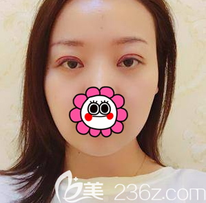 黃海濱給我做眼綜合術(shù)后當(dāng)天照