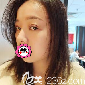 我在北京圣嘉新做眼綜合第4天樣子