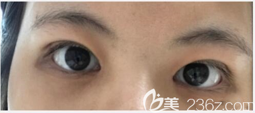 韓國soonplus做了埋線雙眼皮+提肌+內(nèi)眼角真人案例 韓國soonplus做了埋線雙眼皮+提肌+內(nèi)眼角真人案例