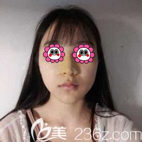 在梵童醫(yī)療美容做鼻綜合術(shù)后5天<span style= 在梵童醫(yī)療美容做鼻綜合術(shù)后5天<span style=