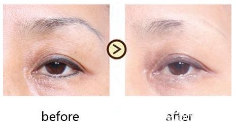皮秒激光洗眉成功的術(shù)前術(shù)后對比照