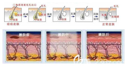 做光子嫩膚去痘印的優(yōu)勢(shì)