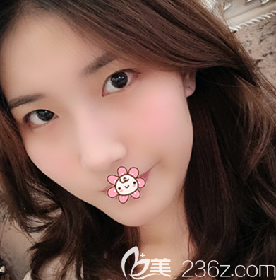 在珠海新顏?zhàn)鲭p眼皮術(shù)前照片 在珠海新顏?zhàn)鲭p眼皮術(shù)前照片