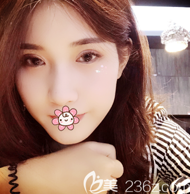 珠海雙眼皮一個(gè)月<span style= 珠海雙眼皮一個(gè)月<span style=