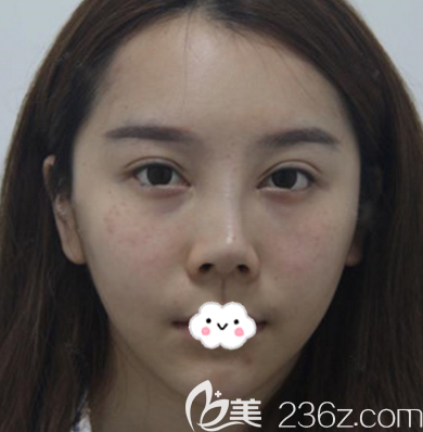 去珠海新顏?zhàn)雎”切迯?fù)術(shù)前照片 去珠海新顏?zhàn)雎”切迯?fù)術(shù)前照片