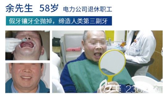 假牙鑲牙全拋掉換上全口種植牙