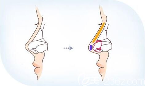 鼻小柱延長一般用什么材料