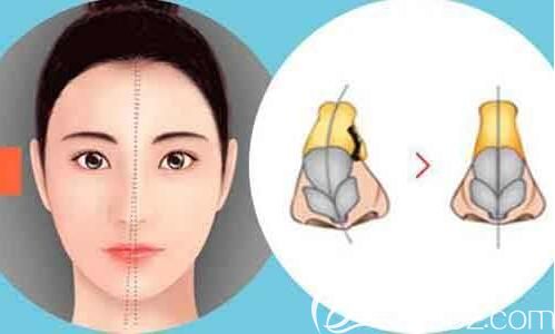 鼻小柱延長用那個材料好？