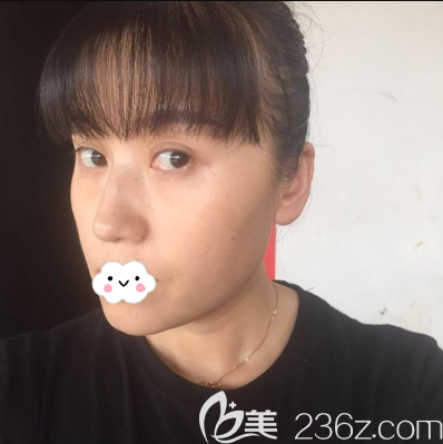 成都美容整形醫(yī)院任華英給我做的激光祛斑效果比我抹祛斑霜強(qiáng)多了