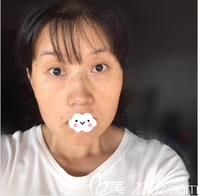 激光祛斑術(shù)后7天恢復(fù)圖