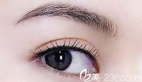 切開雙眼皮效果圖