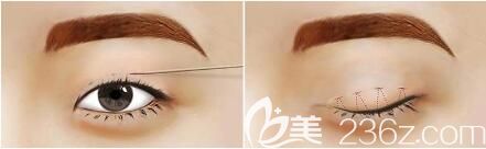 微創(chuàng)雙眼皮是韓式定點(diǎn)雙眼皮