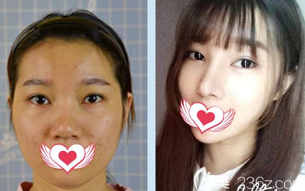 焦俊光院長做假體隆鼻+耳軟骨隆鼻案例效果對比圖