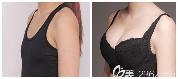 黎石峰院長做自體脂肪豐胸案例效果對比圖