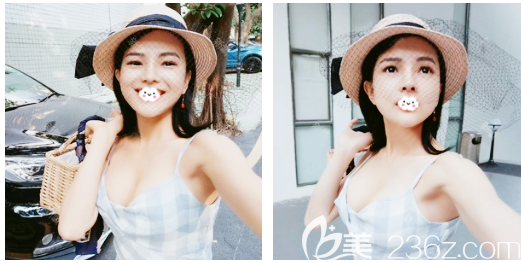 玉兔動(dòng)感隆胸術(shù)后一個(gè)月效果 玉兔動(dòng)感隆胸術(shù)后一個(gè)月效果