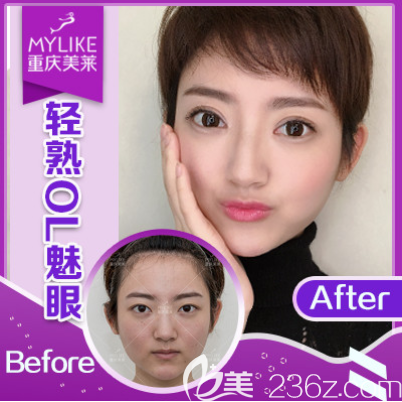 重慶美萊雙眼皮怎么樣 重慶美萊雙眼皮怎么樣