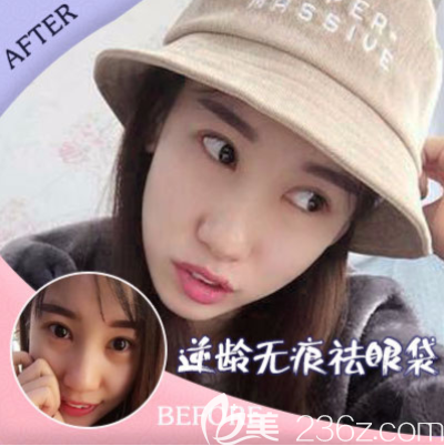 重慶美萊祛眼袋 重慶美萊祛眼袋